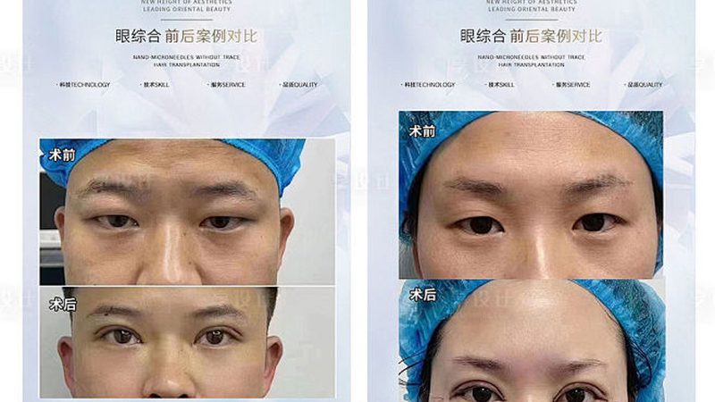 玻尿酸，美丽肌肤的“水光”之源——揭秘化妆品级玻尿酸的奥秘