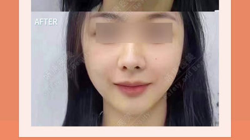 激光术后修复医用面膜：揭秘选择与使用之道