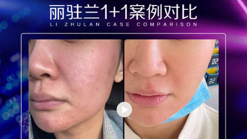 玻尿酸代加工：揭秘其背后的资质与标准**