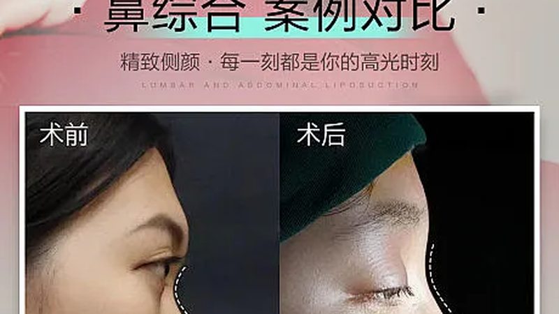 瘦脸操VS面部瑜伽：揭秘两种瘦脸方式的本质区别