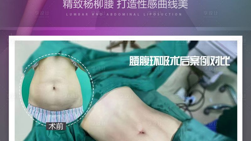 自体软骨隆鼻，术前准备清单全解析