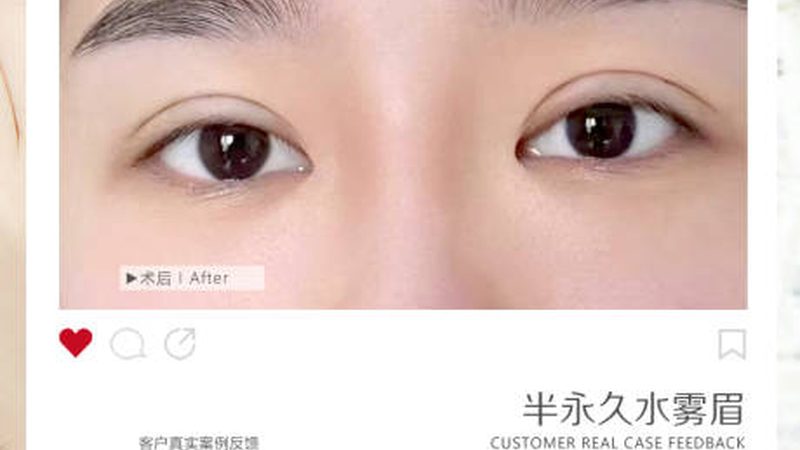 双眼皮手术的恢复周期一般为1-3个月。在这期间，可以通过以下方式判断恢复情况：