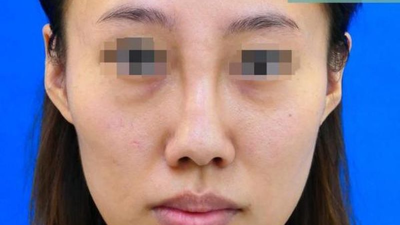国产水光针，揭秘其成分与功效背后的科学